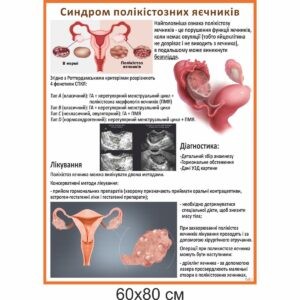 синдром полікістозних яєчників, стенд купити, медичні стенди, стенди в медунівер
