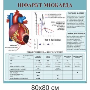 стенди купити, стенди замовити, стенди Україна, стенди для внз, стенди для вищої освіти, медичні стенди, медицина, стенди з медицини, інфаркт, інфаркт міокарда,